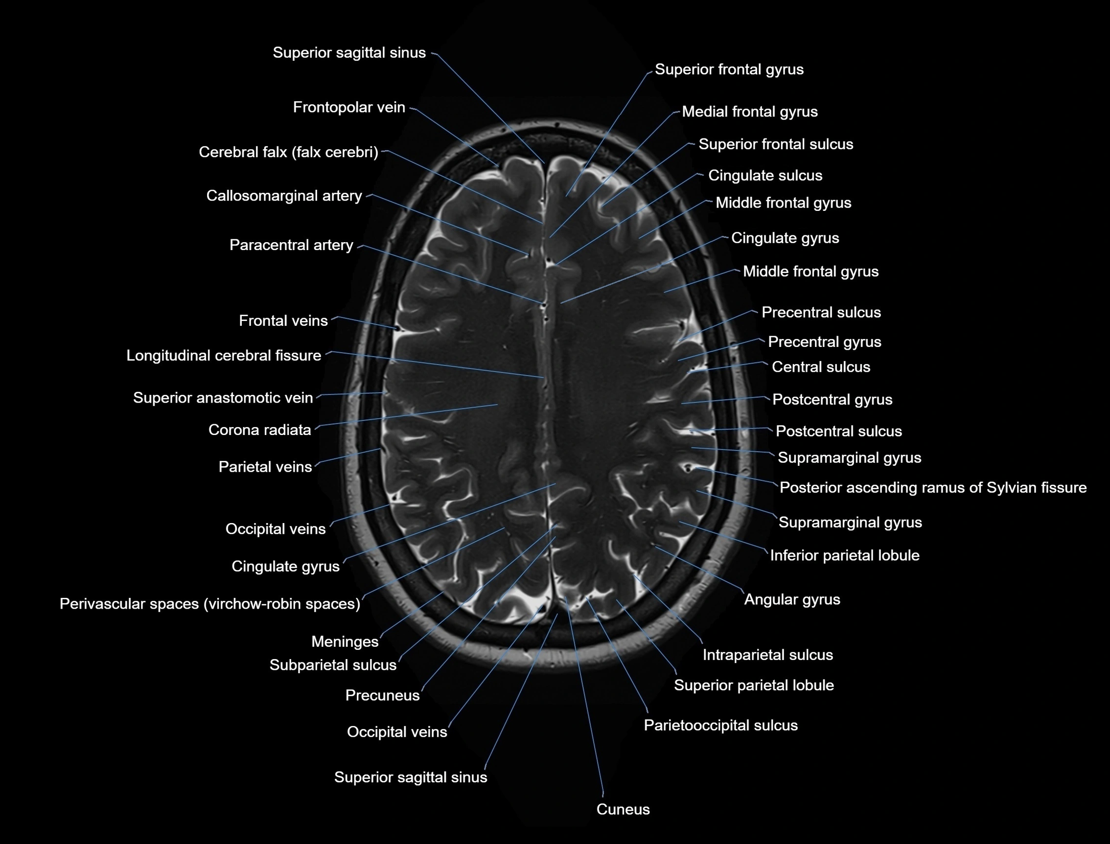 MRI Brain axial cross sectional radiology anatomy 3T image  -img-00001-00041.webp